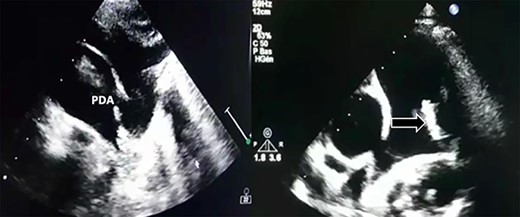 Large PDA and a fixed structure on the wall of the pulmonary artery.