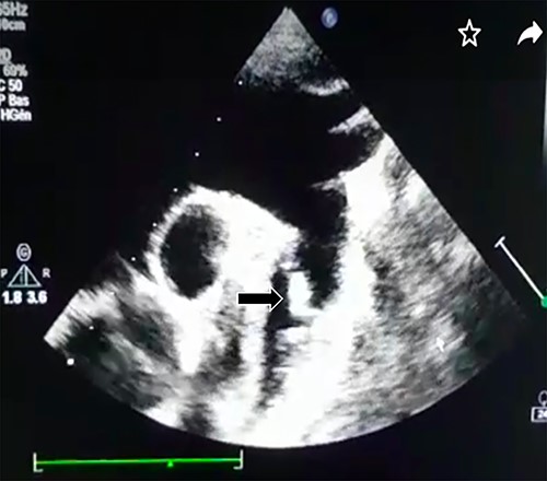 Supra-sternal view: vegetation attached to the wall of the descending aorta.