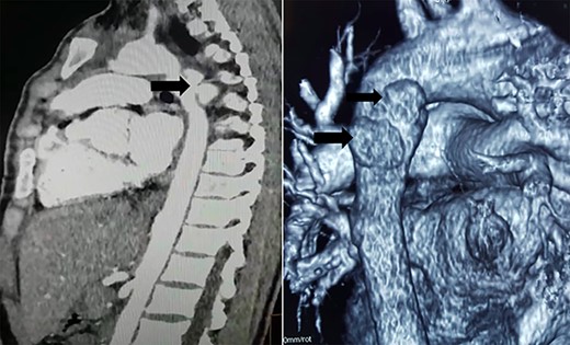 CT scan showing two mycotic pseudoaneurysms of the descending aorta.
