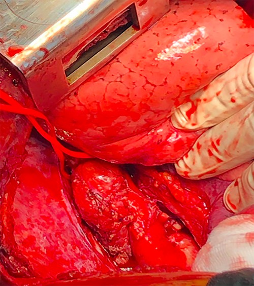 Preoperative image showing two juxta-ductal aneurysmal formations.