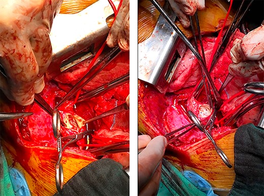 Preoperative image after opening of the descending aorta; left: vegetations on the wall of the aorta; right: closure of the false aneurysms by direct sutures.