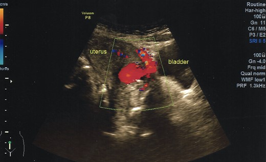 Ultrasonography demonstrates a rich blood flow in the lower uterine segment with a normal fundus.