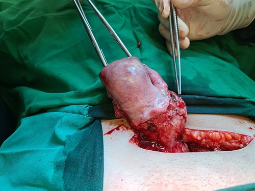 A bulging mass with intact serosa was observed in the left lower uterine segment.
