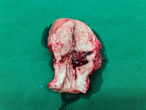 The gross specimen showing a cesarean scar pregnancy.
