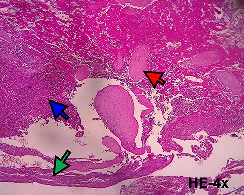 Histopathological examination confirmed the diagnosis of cesarean scar pregnancy (red arrow = necrotic villi chorealis; green arrow = fibromuscular tissue and blue arrow = necrotic tissue).