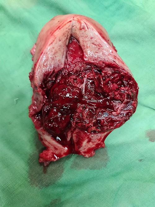 Gross specimen of the uterus. A mass in the lower uterine segment was observed, which did not penetrate the serosal layer.