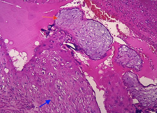 Microscopic image (hematoxylin and eosin, 40×) showing villi chorealis embedded in fibromuscular tissue (red arrow: villi chorealis and blue arrow: fibromuscular tissue).