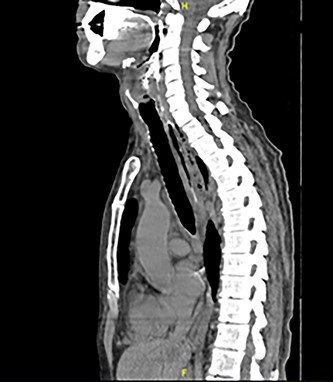 Sagittal plane CT neck and thorax with oral contrast showing significant parapharyngeal gas.