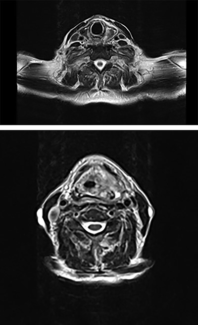 Axial plane MRI of neck and thorax showing a heterogenous collection on left parapharyngeal space extending inferiorly.