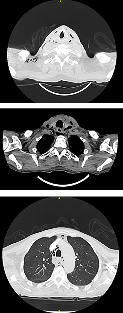Axial planes CT neck and thorax showing left parapharyngeal abscess with tracking into the prevertebral space, significant progression of air pockets in mediastinal and cervical soft tissue extending to right axillary region.