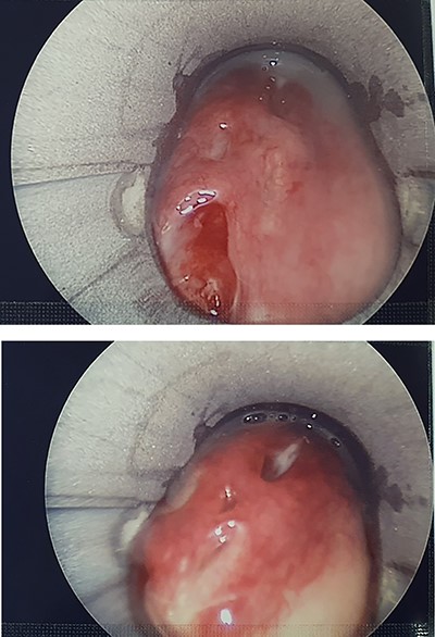 Pharyngoscopy showing slit-like mucosal perforations in left posterior pharyngeal wall and left piriform fossa with muco-purulent discharge.