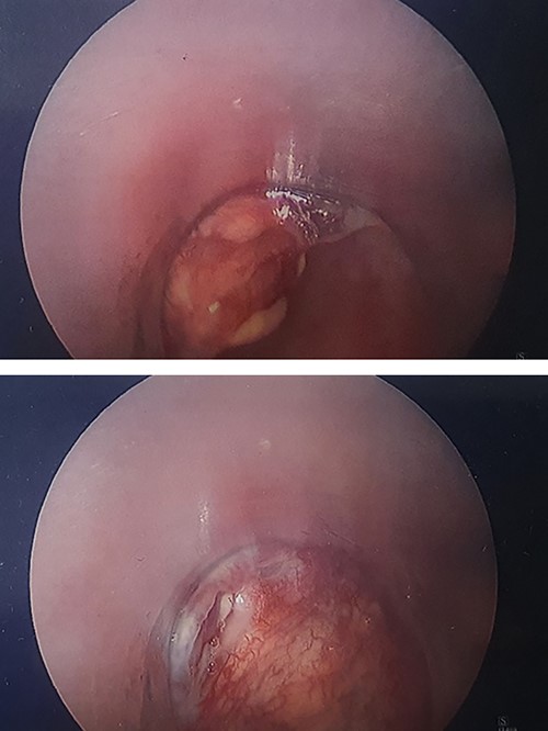 Pharyngoscopy showing healing perforations.
