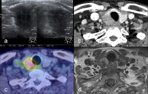 (a) Cervical ultrasound examination: a hypoechoic nodule with indistinct borders and irregular margins (15 × 23 × 25 mm) was found at the inferior pole of the right lobe. (b) Dynamic CT scan: a mass lesion (18 × 24 × 26 mm) was found in the inferior pole of the right lobe thyroid gland without contrast effect in equilibrium phase. (c) PET/CT scan: FDG hyperaccumulation was observed in a nodule (~25 mm diameter) at the inferior pole of the right lobe of the thyroid gland. (d) MRI scan: A mass (30 mm diameter) with mildly high signal on Dixon-T2-weighted imaging was found at the inferior pole of the right lobe of the thyroid gland, and tracheal invasion. Extracapsular invasion was suspected. Abbreviations: CT, computed tomography; PET, positive emission tomography; FDG, fluorodeoxyglucose; MRI, magnetic resonance imaging.