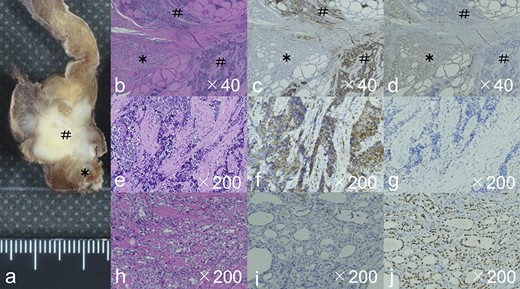 The gross image (a) showed a white mass with very close Carcinoma showing thymus-like differentiation, CASTLE (#) and papillary thyroid carcinoma, PTC (*). HE staining showed the CASTLE had chordate and small enriched structures (b), and the tumor cells showed a very high N/C ratio, large oval nuclei, chromatin densification, and often lymphocytic infiltration around the tumor cells (e). Immunostaining also showed CD5 positivity in CASTLE (c, f), but negativity in PTC (c, i). PTC showed small to medium-sized follicular structures by HE staining (b). Tumor cells showed intranuclear inclusion body, a nuclear groove resembling a coffee bean, and ground-glass appearance (h). Immunostaining showed TTF-1 positivity in PTC (d, j), but negativity in CASTLE (d, g). Abbreviations: CASTLE, Carcinoma showing thymus-like differentiation; PTC: papillary thyroid carcinoma; HE stain, hematoxylin and eosin stain; TTF-1, thyroid transcription factor-1.