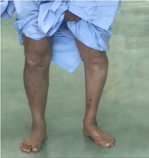 Preoperative left knee genuvarum while standing.