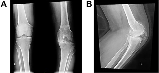 Preoperative plain radiographs; (A) severe osteoarthritic changes affecting the left knee with narrowing of the medial knee joint compartment; (B) left femur with dorsal angulation above the condyles and severe patella baja.