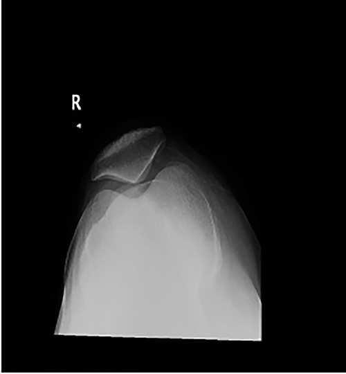 Skyline view showing severe arthritic changes.