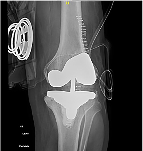 Immediate post-operative plain radiograph.