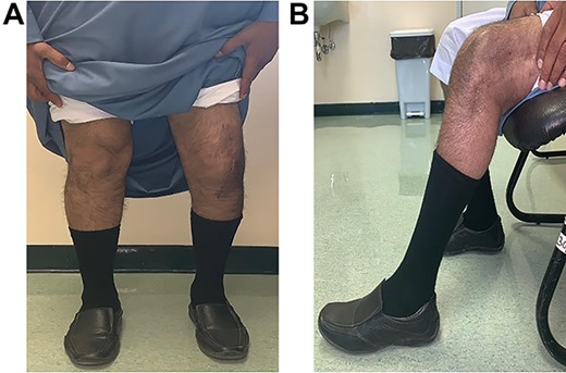 3-month post-operativeROM.