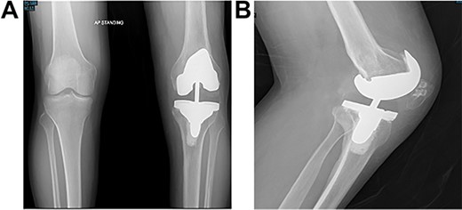 Post-operative plain radiographs from follow-up visits; (A) 3-month post-operative AP radiograph showing implant in place with a lateral gap sized to be 3.2 cm; (B) 3-month post-operative lateral radiograph of the knee showing implant in a satisfactory position.