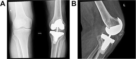 Post-operative plain radiographs at 2-year follow-up visit; (A) 2-year post-operative AP radiograph showing implant in place with decreased lateral gap sized to be 1.57; (B) 2-year post-operative lateral radiograph of the knee showing implant in a satisfactory position.