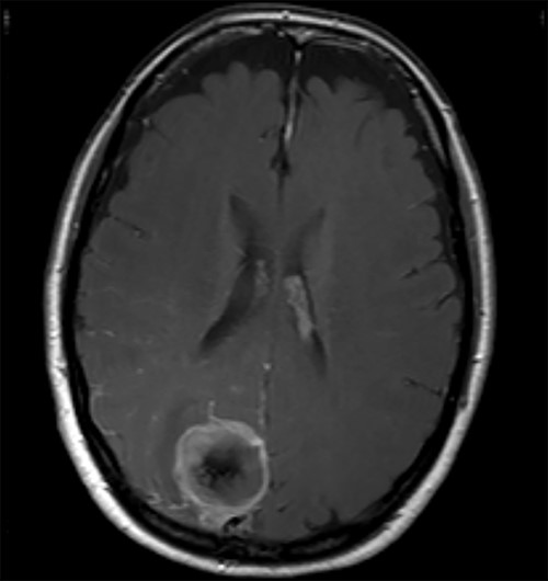 Axial view of a T1 weighted MRI post-gadolinium enhancement demonstrating the appearance of a 3-cm right parieto-occipital extra-axial mass with bony involvement and adjacent small nodule. Most in keeping with a meningioma.