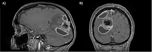 T1 weighted MRI postgadolinium enhancement in both sagittal (A) and coronal (B) views. There are two new rim-enhancing cystic lesions. A superior lesion of 31.4 mm as measured on the coronal reconstructed images and is abutting the adjacent dura of the right parietal lobe and is sited superior and lateral to the right occipital lesion. Another lesion sited inferior to the known right occipital lesion is the larger of the two lesions and has a septation within it. This measures approximately 34.4 mm on the coronal reconstructed images. On the sagittal images, it can be seen that the anterosuperior enhancing border of this lesion has a thicker and more ill-defined age. There is an adjacent vasogenic oedema.