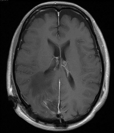 T1 weighted axial MRI postgadolinium enhancement within 48 h post-operatively. Small amount of enhancement within the surgical bed remains. Good resection margins with vasogenic oedema. This may represent a small residual. The rim-enhancing cystic lesions appear to have resolved.