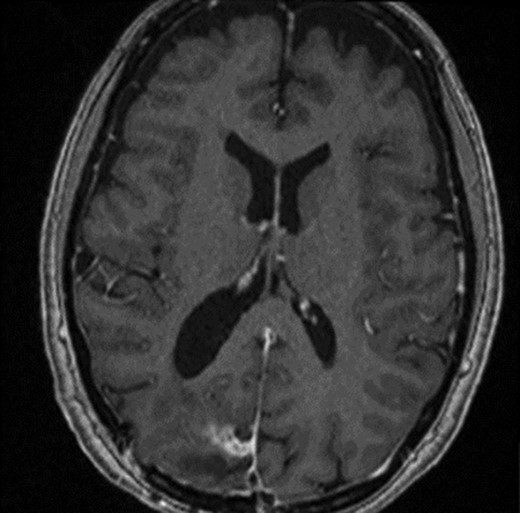 T1 weighted axial MRI post-gadolinium enhancement 8 weeks postdischarge. Right occipital postsurgical appearances are again demonstrated with reduction in the extent of vasogenic oedema. The enhancing rim that was present previously has retracted, with only focal curvilinear enhancement now evident in the right occipital lobe. These appearances are likely postsurgical/treatment related, and there is no convincing residual or recurrent disease.