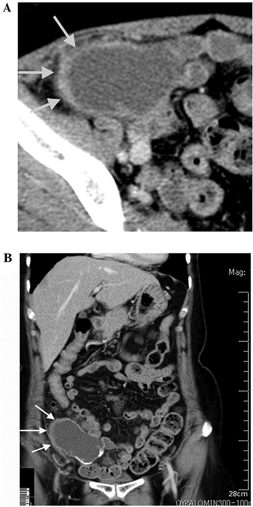 CT scan showing lobulated cystic formation in the right iliac vessels level with an extension to the upper margin of the pelvis. This finding is suspicious, so a decison was made for excision of the tumor and to be sent to pathology department to confirm the diagnosis.