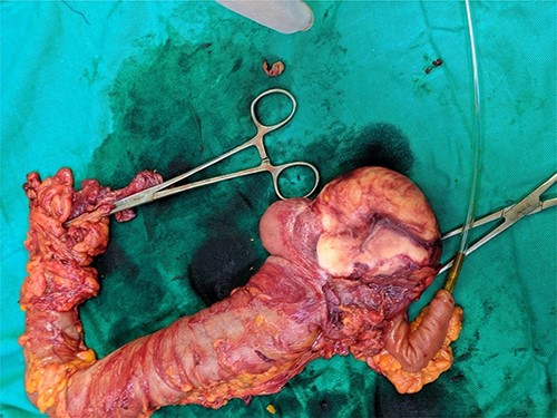 A gross appearance of the right excised colon.