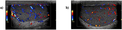 Sonographic appearances of (a) right testis and (b) left testis with colour doppler demonstrating adequate perfusion.