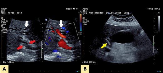 (A) Transverse oblique US reveals segmental wall thickening of the common hepatic duct (between red arrows) with intrahepatic duct dilatation (white arrows). (B) Distended gall bladder with calculus in the neck (yellow arrow).