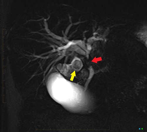 2D projectional MRCP reveals abrupt segmental stricture (red arrow) of the common hepatic duct with marked intrahepatic biliary dilation. Gall bladder is distended and there is a calculus (yellow arrow) in the gall bladder neck.