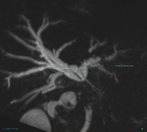 MIP reconstruction of 3D MRCP reveals abrupt segmental stricture of the common hepatic duct with marked intrahepatic biliary dilation. Trifurcation of the biliary confluence into the left hepatic duct, aberrant segment 6 duct and the right hepatic duct. The right hepatic duct is formed by the union of right anterior (segment 5,8) duct and segment 7 duct while the segment 6 duct is joining separately at the confluence. The approximate plane of surgical resection is indicated.