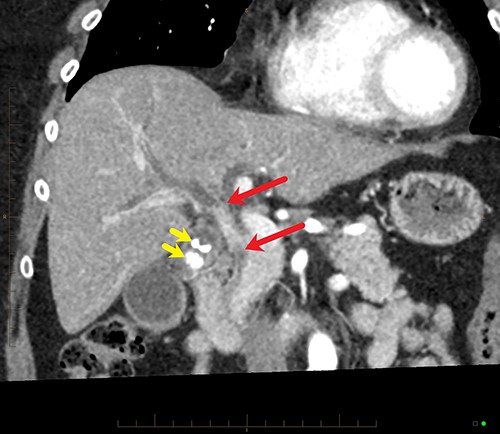 Coronal MPR of late arterial phase CT reveals segmental common hepatic duct stricture with circumferential wall thickening and enhancement (between red arrows) resulting in intrahepatic duct dilatation. Radiopaque calculi (yellow arrows) in the gallbladder.