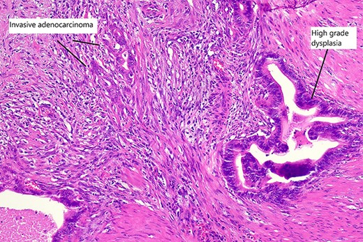 High magnification slide showing high-grade dysplasia and invasive adenocarcinoma of the gallbladder after haematoxylin and eosin staining.