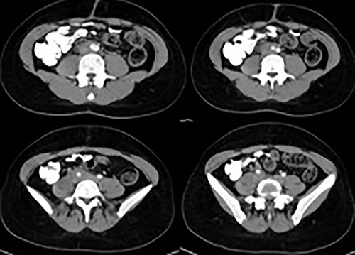 CT of the abdomen revealed a mass encloses the abdominal aorta and the arterial and venous axes as well as the right ureter.