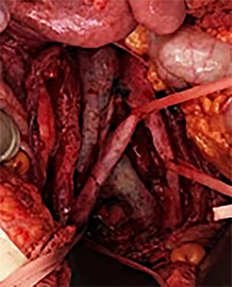 During the operation, the mass was detached from the abdominal aorta and common iliac arteries and veins.