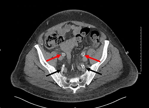 Axial slice of a non-contrast CT AP with red arrows showing calcified external iliac arteries and black arrows showing calcified internal iliac arteries.