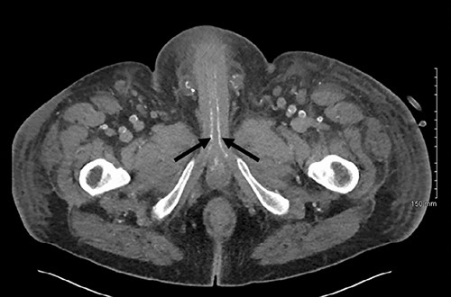 Axial slice of a non-contrast CT AP with arrows delineating calcified cavernosal arteries.