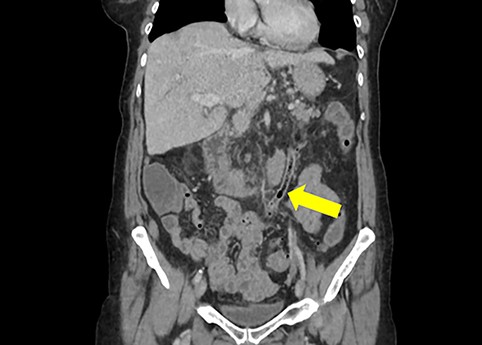 Coronal section of non-contrast CT scan demonstrating the colovenous fistula between the inferior mesenteric vein and sigmoid colon (yellow arrow); air is seen tracking within the lumen of the inferior mesentericvein.