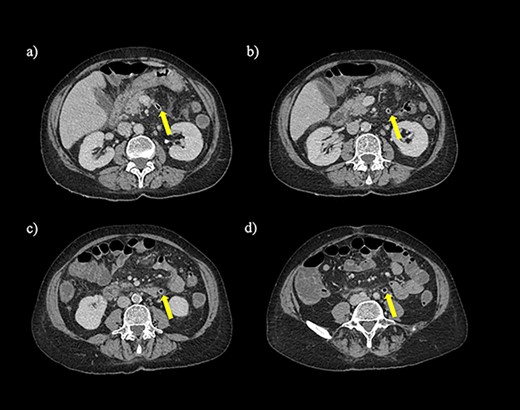 Axial section of a non-contrast CT scan with showing air tracking within the inferior mesenteric vein at various levels (yellow arrow).