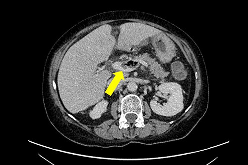Axial section of a non-contrast CT scan with yellow arrow showing portal vein thrombosis with extension to the left intrahepatic portalvein.