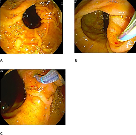 (A) duodenal diverticulum type C of Noda Classification; (B) bile duct deep cannulation; (C) sphincterotomy.