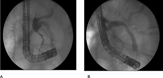 (A) cholangiography shows the bile duct with an extrinsic compression by the duodenal diverticulum witch conditions an angulation; (B) cholangiography after use the retrieval ballon catheter shows absence of stones.