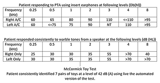 Pure tone audiometry (PTA) results of patient at presentation for consideration ofCI.