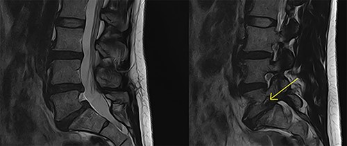 Preoperative MRI lumbar spine (mid- and para-sagittal slices of T2 weighted sequence) demonstrating posterior bulging of the L4/5 and L5/S1 discs in conjunction with a Grade 1 spondylolisthesis of L5 on S1 resulting in significant right-sided foraminal stenosis at L5/S1 (indicated by yellow arrow).