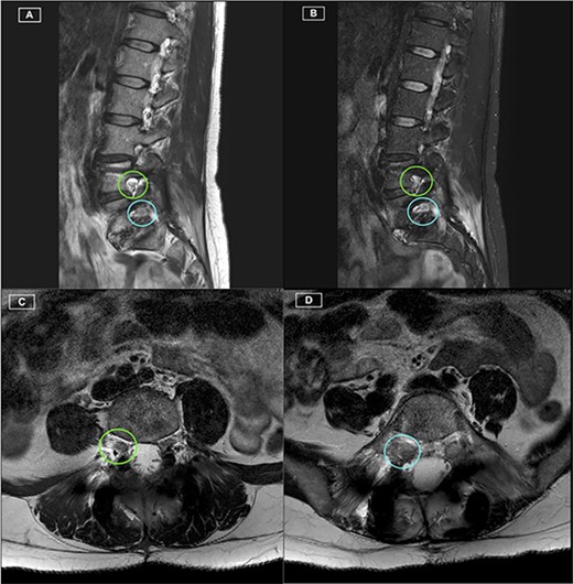 Postoperative MRI Lumbar spine. (A) Right-sided parasagittal slice of T2 Sequence MRI. Right L4/5 foramen (superior) and Right L5/S1 foramen (inferior) have been highlighted, with excellent definition of the Right L4 and L5 nerve roots. (B) Right-sided parasagittal slice of Short Tau Inversion Recovery (STIR) Sequence MRI. Exiting L5 nerve root is well visualised, with evident perineural thickening. (C) Axial slice of T2 Sequence MRI at the level of the L4/5 Foramen. The Right L4 nerve root is identified with excellent visualisation. (D) Axial slice of T2 Sequence MRI at the level of the L5/S1 Foramen. The Right L5 nerve root is identified with excellent visualisation.