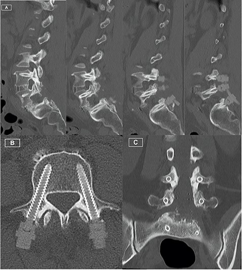 Postoperative CT Lumbar spine. (A) Sequence of sagittal slices demonstrating excellent definition of screw trajectory. (B) Axial slice through L4 pedicles demonstrating definition of screws and distinction from bony cortex. (C) Coronal slice demonstrating screws at all levels with no peri-structural artifact.